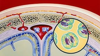 Acute Pediatric Bacterial Meningitis Due to the Rare Isolate Pseudomonas putida A Case Report [upl. by Tfat]