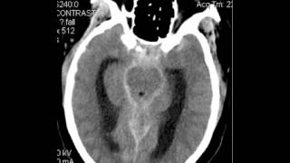 CT Head Subarachnoid Hemorrhage DISCUSSION by Radiologist [upl. by Yendyc]