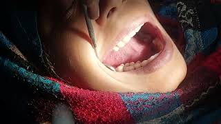 Root Canal Opn And infected Toothwarm please Channel ko Subseribe kre [upl. by Kcir]