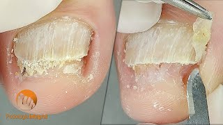 2 cases 1 video XI  1 Onychomycosis  2 Onychogryphosis Podological treatment [upl. by Onilecram974]