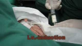 Ambu AuraOnce  Laryngeal Mask  Insertion in real patient [upl. by Erlina]