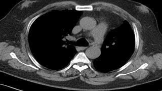 Cross sectional and imaging anatomy of the thorax [upl. by Lowndes]