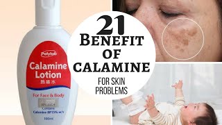 CALAMINE lotion  Lacto calamine lotion uses in detail side effects [upl. by Nehepts151]