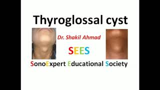 Thyroglossal Cyst [upl. by Fanya]