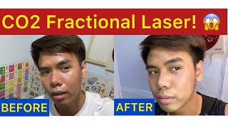 CO2 Fractional Laser  Treatment para matanggal ang Acne Scars Lines and Dark Spots Philippines [upl. by Noram]