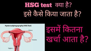 HSG test in Hindi  HSG test Procedure and cost in Hindi [upl. by Anelec]