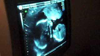 Ultrasound Anatomy Scan  19 Weeks  MUSC Health [upl. by Thackeray]