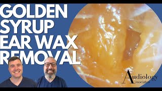 GOLDEN SYRUP EAR WAX REMOVAL  EP888 [upl. by Ahsitahs]