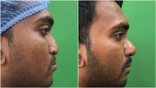 Rhinoplasty Results  Binders Syndrome Nose Deformity  Dr Jayanta Bain Plastic Surgeon [upl. by Eelrebmik567]