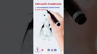 Mnemonic Edwards Syndrome neet fmge usmle biology [upl. by Evad]