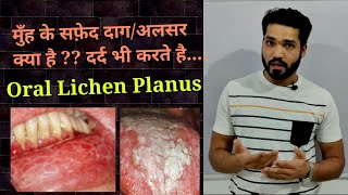 Oral lichen planus  appearance amp causes  kya oral lichen planus cancer hai [upl. by Naujuj]