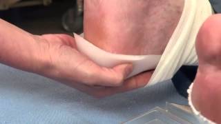 Pressure Ulcer Prevention ADERMA◊ Dermal Pad Heel Application [upl. by Haggerty207]