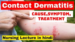 contact dermatitis  cause symptoms treatment nursing care  nursing lecture in hindi  msn [upl. by Hester566]