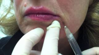 Juvederm for Smile Lines [upl. by Alexandros]