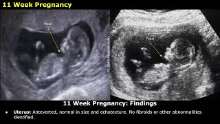 Obstetric Ultrasound Reporting  How To Write USG Reports  Pregnancy Sonography  TIFFA Scan [upl. by Eneleuqcaj67]