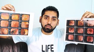 Proof that Ulcerative Colitis can be HEALED CURED amp REVERSED  Heal Ulcerative Colitis [upl. by Iruj]