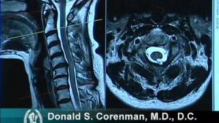 How to Read a MRI of Cervical Stenosis with Spinal Cord Injury  Spine Surgeon in Colorado [upl. by Marcel845]