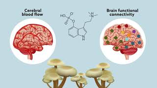 Psilocybin may ‘reset’ the brain to help manage treatmentresistant depression [upl. by Ynafit552]