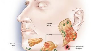 salivary gland tumors [upl. by Sochor]