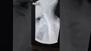 Barium swallow barium study youtubeshorts medicalanimation animation tranding trandingshorts [upl. by Rufe]