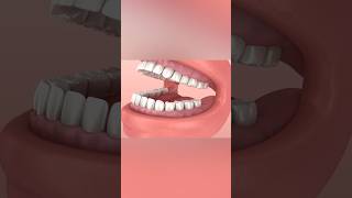 Wisdom tooth problem dentist teeth [upl. by Frey]