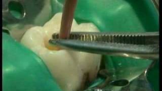 Endodontie mécanisée le système PROTAPER® principes et guide dutilisation [upl. by Heyde800]