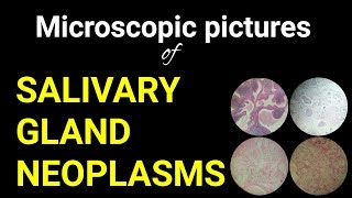 Microscopic pictures of salivary gland neoplasmsDr Poojireddy oral pathology [upl. by Saunders]