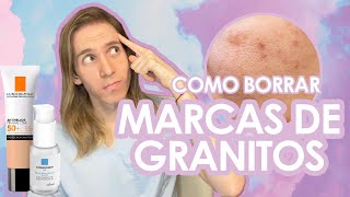 COMO BORRAR MARCAS DE ACNE de manera rápida y segura [upl. by Aisat]