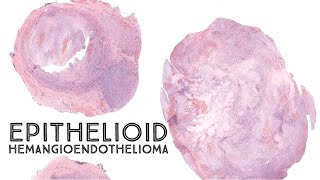 Epithelioid hemangioendothelioma EHE Australasian Dermpath 2022  Case 9 pathology dermatology [upl. by Revell]