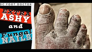 Extra Ashy Severely Dry Skin and Fungal Nails In A Diabetic Patient Part 2 of Xerosis Cutis [upl. by Obala209]