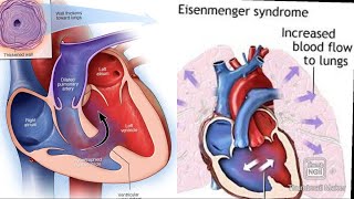 Eisenmenger syndrome fmge next neetpg [upl. by Yraek375]