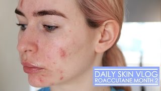 Roaccutane Daily Skin Vlog  Month 2 [upl. by Eenahc]