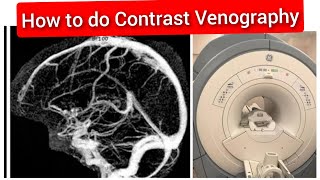 Contrast Venography MRI Scan Protocol Positioning amp Planning  Live Demo in English [upl. by Iderf]