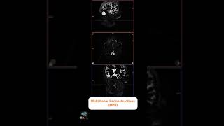 MRI SIALOGRAPHY [upl. by Melac]