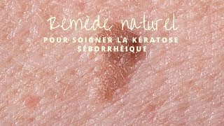 Remède naturel pour soigner la Kératose Séborrhéique [upl. by Llewol606]