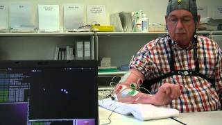 BrainComputer interface used for rehabilitation after a stroke [upl. by Atneuqal]