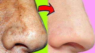 Uses Of Baking Soda On Face  Baking Soda Hacks Ways To Use Baking Soda For Skin CareShinnyroops [upl. by Varion]