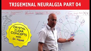 Trigeminal Neuralgia  Causes and Treatment  Part 4 [upl. by Mort351]