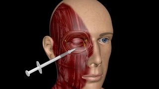 3D MEDICAL TRAINING PROGRAM  BLEPHAROSPASM TREATMENT [upl. by Anniram]