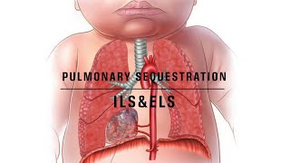 Pulmonary sequestration notes [upl. by Hurless]