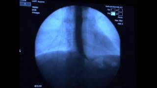 Barium esophagogram [upl. by Leahcimsemaj]