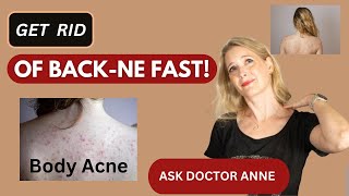 Say Goodbye to Body Acne Simple Steps to Clear Skin  Back and Body Acne Treatment  Doctor Anne [upl. by Skcirdnek664]