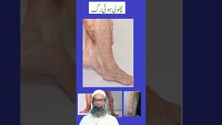 Varicose Veins  Part 1  Causes Symptoms and Homeopathic treatment  Shahbaz Qamar [upl. by Ramilahs]