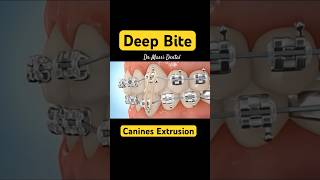 CANINE EXTRUSION Braces  Orthodontics treatments [upl. by Hopfinger361]