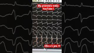 Tachycardie à QRS larges  ma première vidéo d’il y a 5 ans [upl. by Ebeneser]