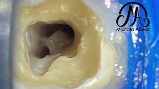 CShaped Lower Second Molar  Root Canal Morphology  Complex RC Anatomy  Endodontic Variations [upl. by Stamata]