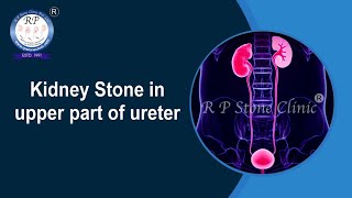 Kidney Stone in upper ureter Animation  Kidney Stone [upl. by Na]