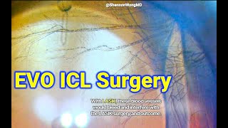 EVO ICL with cornea neovascularization Shannon Wong MD [upl. by Tur814]