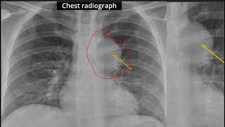 Case Discussion  Anterior Mediastinal mass [upl. by Haines]