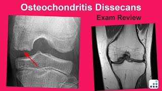 Osteochondritis Dissecans Exam Review  Mark Pagnano MD [upl. by Oys100]